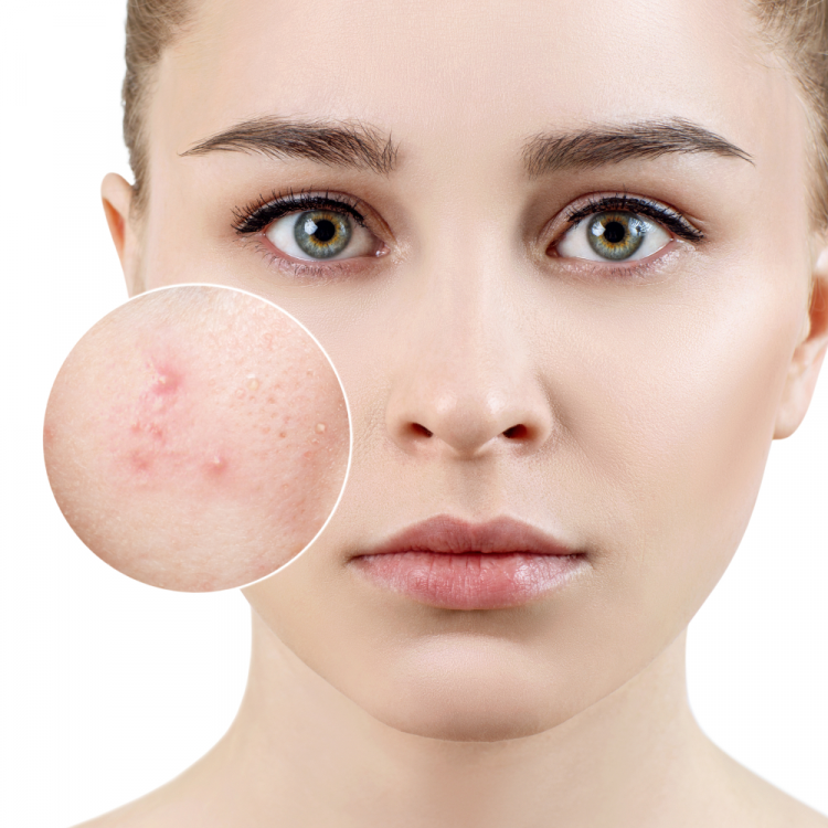 Những loại kem chống nắng Avene nổi đình đám được thế giới yêu thích hiện nay 9 Sản phẩm tránh sinh mụn rất tốt nhờ khả năng kiểm soát nhờn