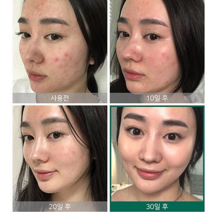 Toner là gì? Review top 10 toner tốt nhất nên dùng hiện nay 14 Sản phẩm được chiết xuất 100% từ cây tràm trà giúp loại bỏ và ngăn ngừa những vết mụn,giảm nhỏ các lỗ chân lông,làm mịn da và dưỡng ẩm cho da.