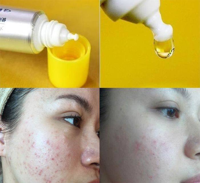 Serum là gì? Review top serum trị mụn và mờ thâm tốt nhất hiện nay 21