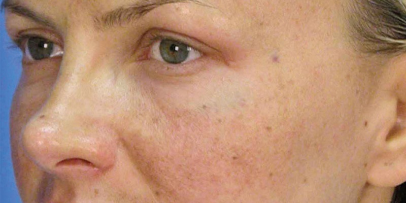 Tàn nhang là các chấm nhỏ sậm màu xuất hiện trên da mặt