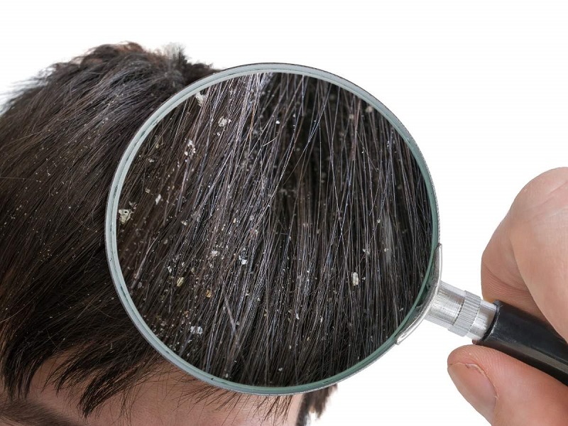 Dùng dầu bơ có thể cải thiện da đầu khô và bong tróc