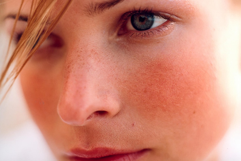 Bệnh rosacea