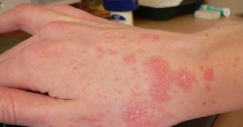 Beta glucan điều trị viêm da, vết thương 