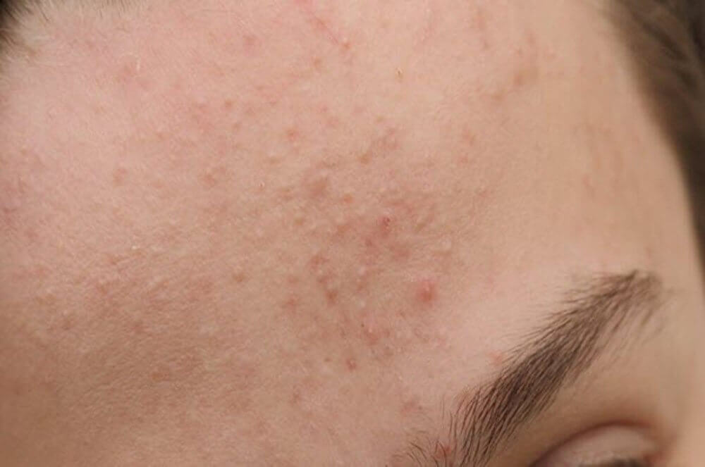 Nguyên nhân gây nên mụn ẩn