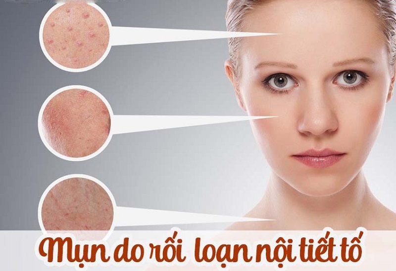 Cách trị mụn nội tiết dứt điểm cho chị em đang cần 2