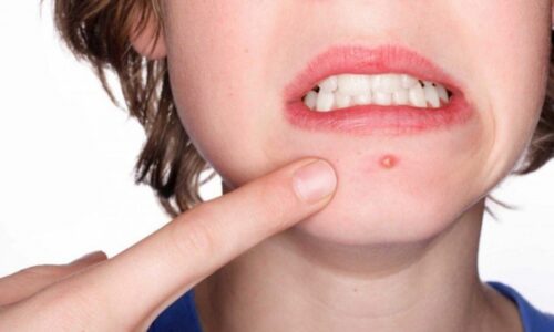 5 cách chữa mụn bọc “siêu đáng ghét” trên mặt