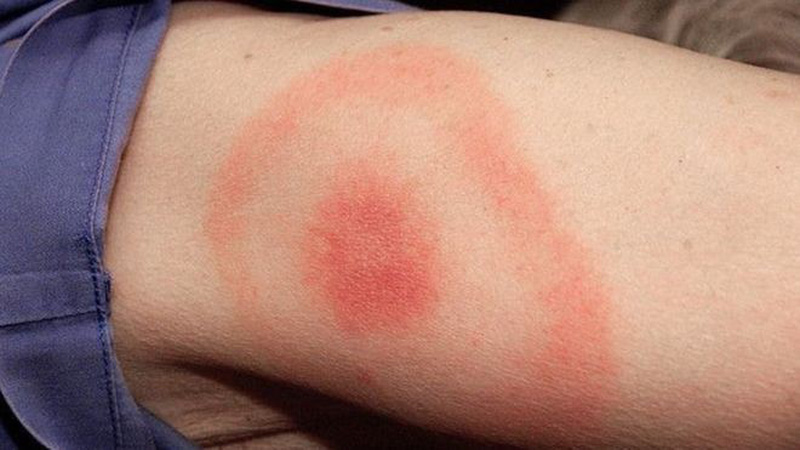 Bệnh Lyme