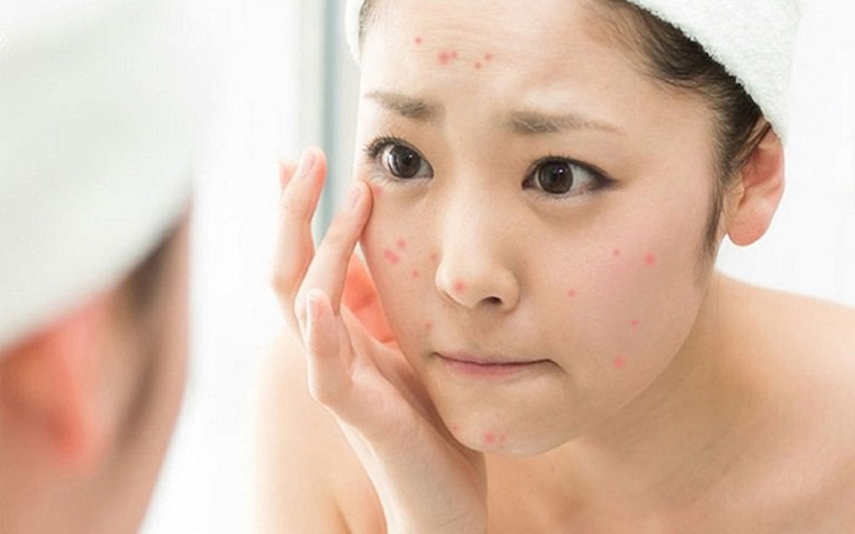 Cách sử dụng kem trị mụn Acnes hiệu quả