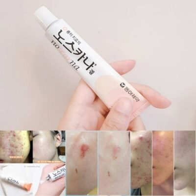 Review 10 thuốc trị sẹo thâm được tìm mua nhiều nhất 2025