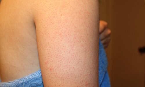 5 cách trị viêm lỗ chân lông bằng dầu dừa tại nhà giúp lấy lại vẻ "tự tin" cho làn da