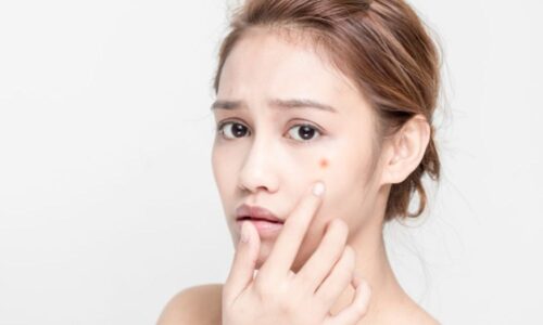 7 cách trị nóng trong người nổi mụn giúp bạn “hạ hỏa” tức thì