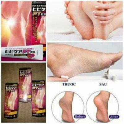 Review 10 kem trị nứt gót chân tốt đáng sử dụng nhất 2025