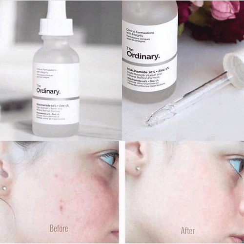 Review 7 serum trị mụn ẩn được “beauty blogger” khen ngợi 2023