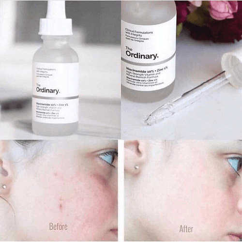 Review 7 serum trị mụn ẩn được “beauty blogger” khen ngợi 2025