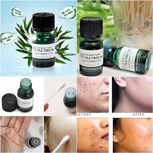 Review 7 serum trị mụn cho da dầu đáng dùng hiện nay 2025