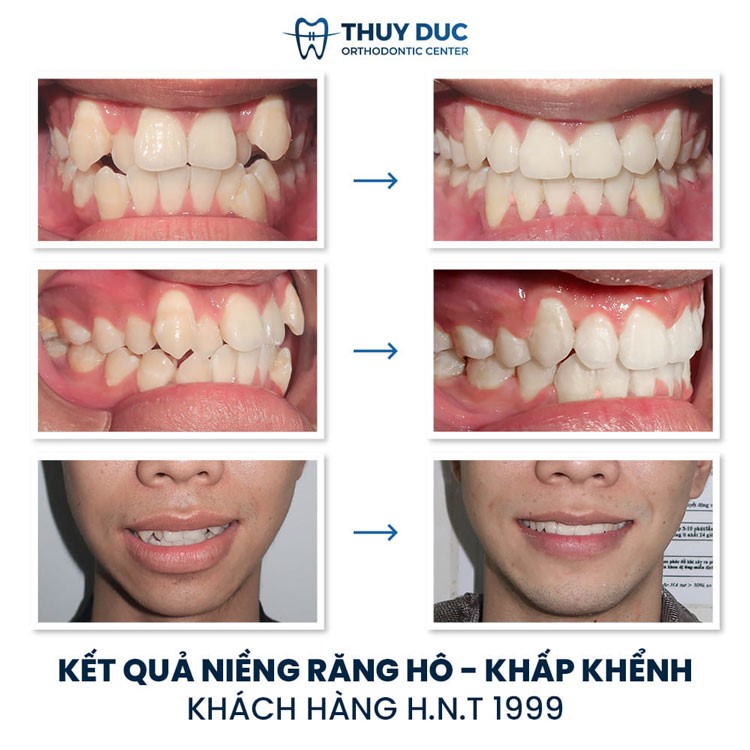 Dựa trên thời gian niềng răng