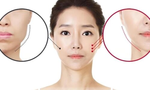 Chi phí tiêm Botox bao nhiêu? Yếu tố ảnh hưởng đến giá tiêm Botox