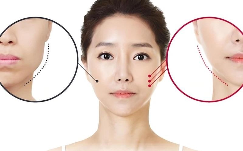 Chi phí tiêm Botox thon gọn hàm có giá từ 1 - 13 triệu đồng lần tiêm